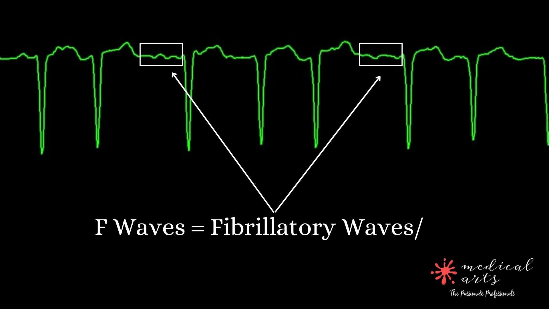Afib - Atrial Fibrillation pathophysiology.