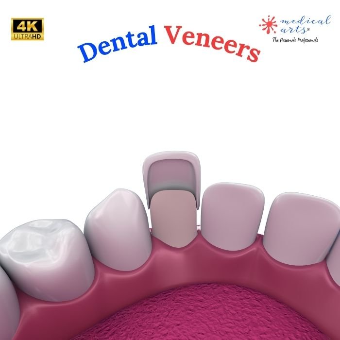 Dental Veneers Procedure - Video & Article