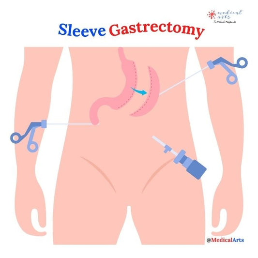 Gastric Sleeve 😷 Bariatric Surgery 🩺 Medical Arts - Medical Arts Shop