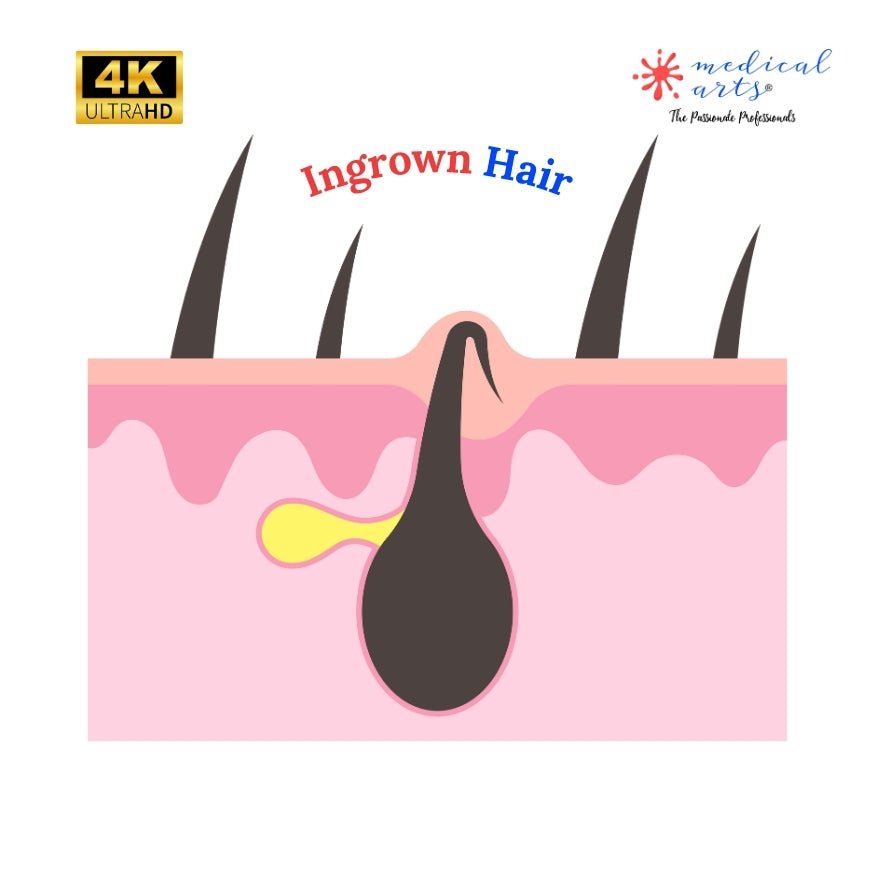 Ingrown Hairs & The Role of Laser Hair Removal