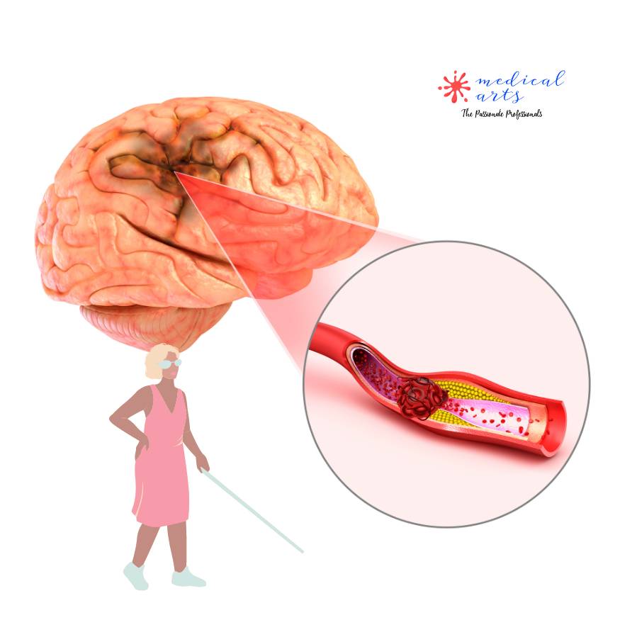 Ischemic Stroke Blood Clot Causes CVA Medical Arts Shop