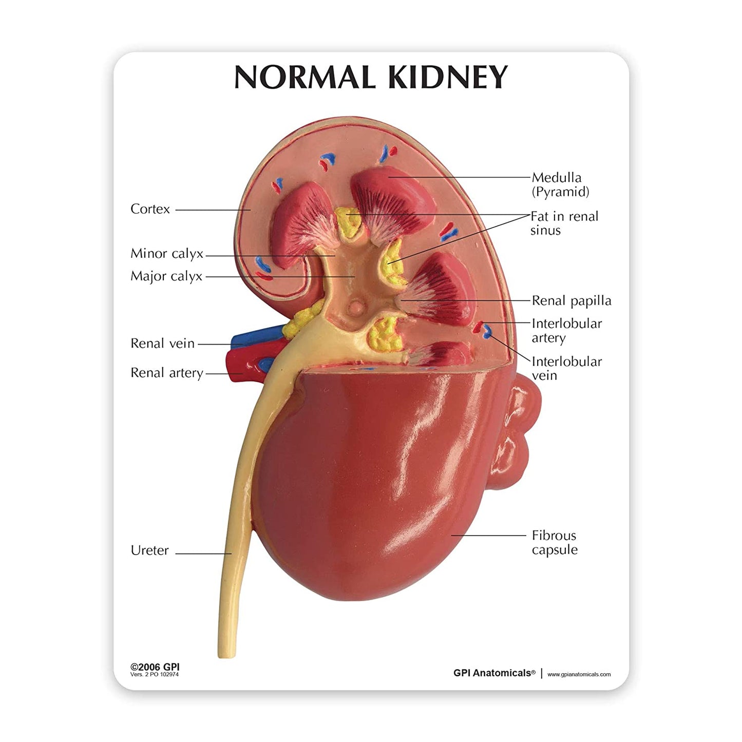 3D Diseased Kidney Dissected Anatomy Model - Medical Arts Shop