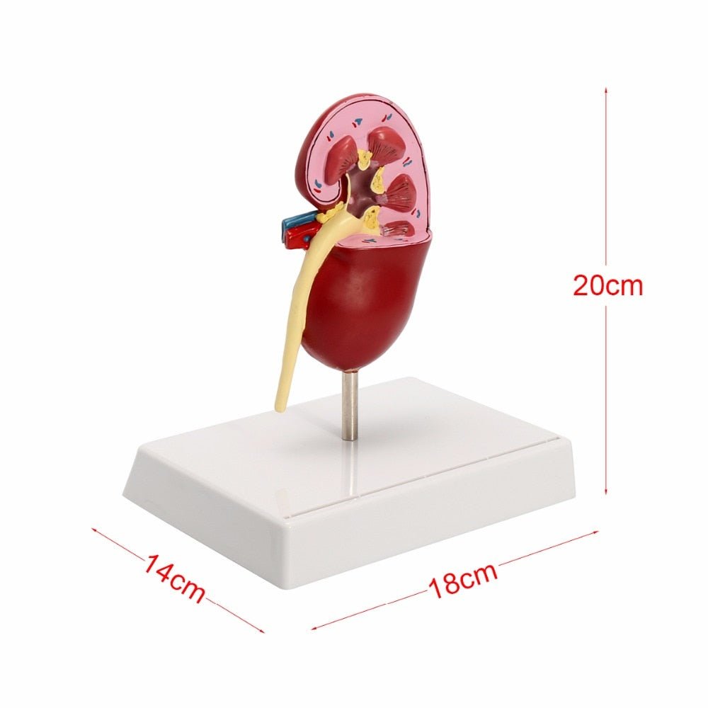 3D Diseased Kidney Dissected Anatomy Model - Medical Arts Shop