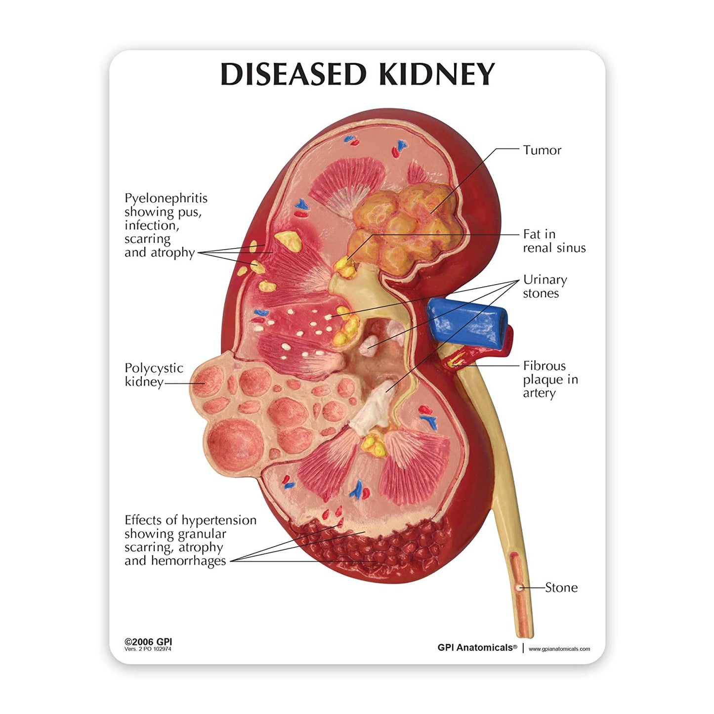 3D Diseased Kidney Dissected Anatomy Model - Medical Arts Shop