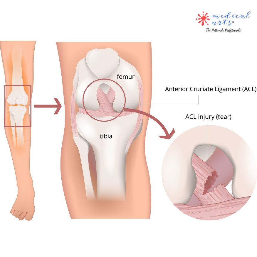 ACL Rupture and Reconstruction: An Overview