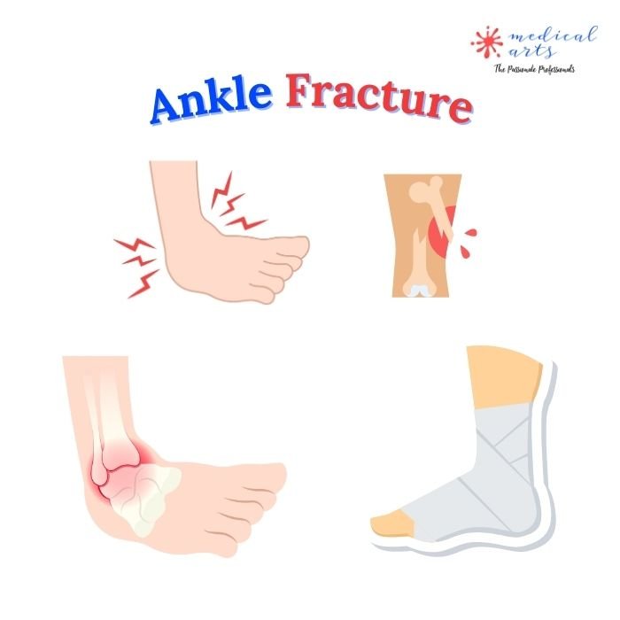 Ankle Fracture: An In-Depth Look - Most recent methods to treat ankle fractures. - Medical Arts Shop