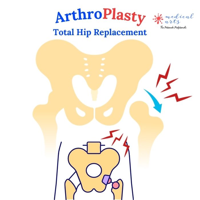 Arthroplasty [] Total Hip Replacement Surgery [] Arthrosis & Arthritis Treatment []   🦴 - Medical Arts Shop