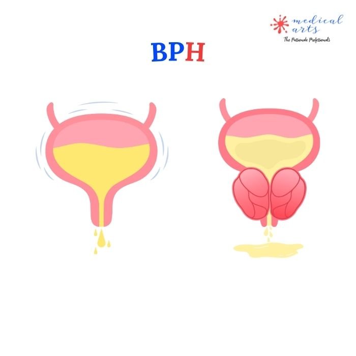 Benign Prostatic Hyperplasia - BPH - Urine Retention - Prostate Enlargement