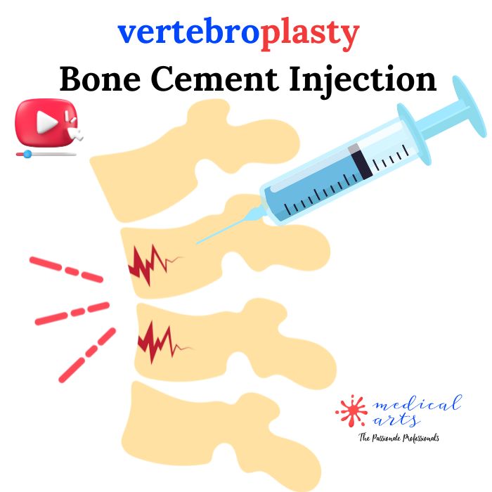 Bone Cement Injection, Vertebroplasty, Percutaneous Vertebral Augmentation.