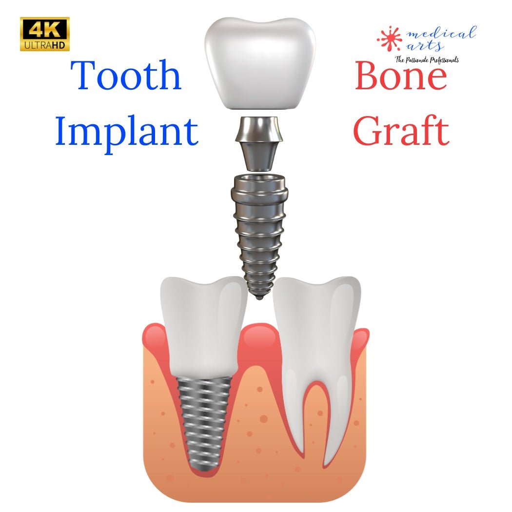 Bone Graft and Tooth Implant - Video included.