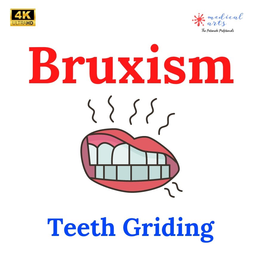 Bruxism, Teeth grinding and all you need to know - Video included.