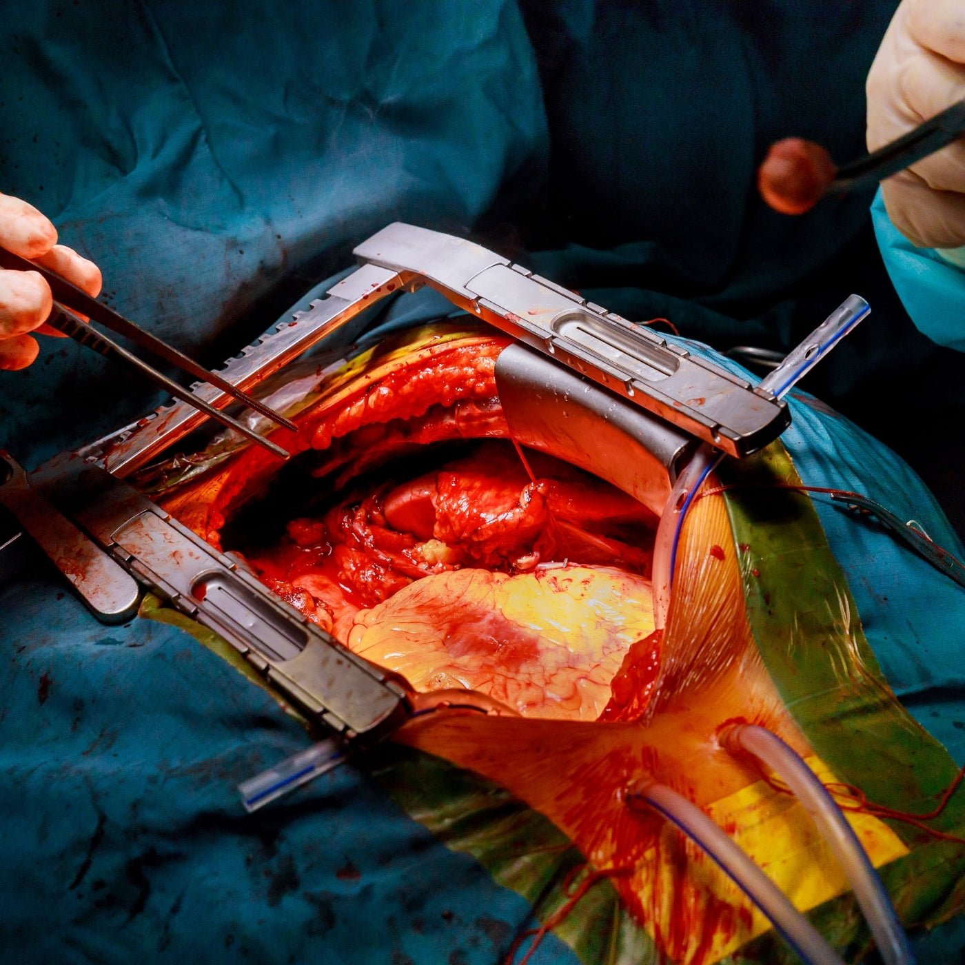 Cardiac transplants - heart transplantation