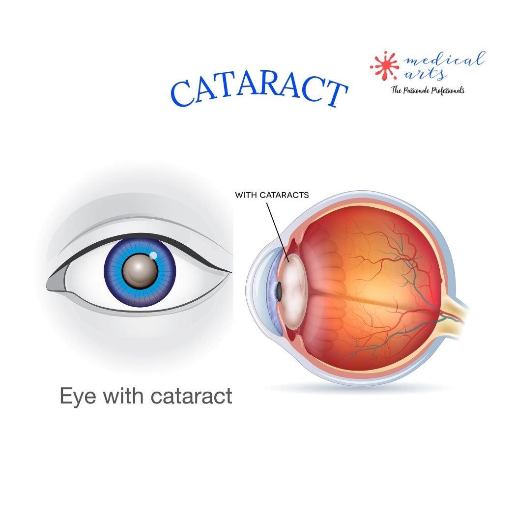Cataract - Lens Implant - Medical Arts Shorts - 3d animation surgery
