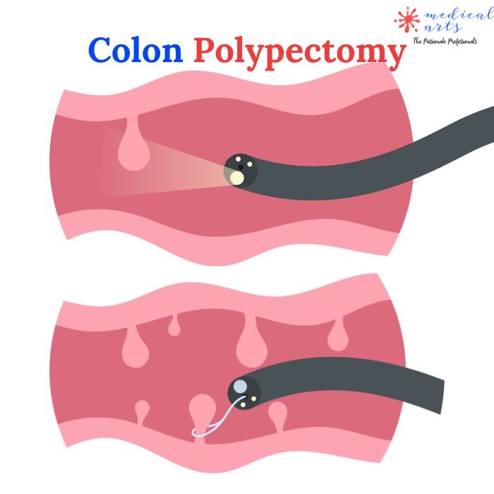 Coloscopy | Colon Polyp Resection | Polypectomy