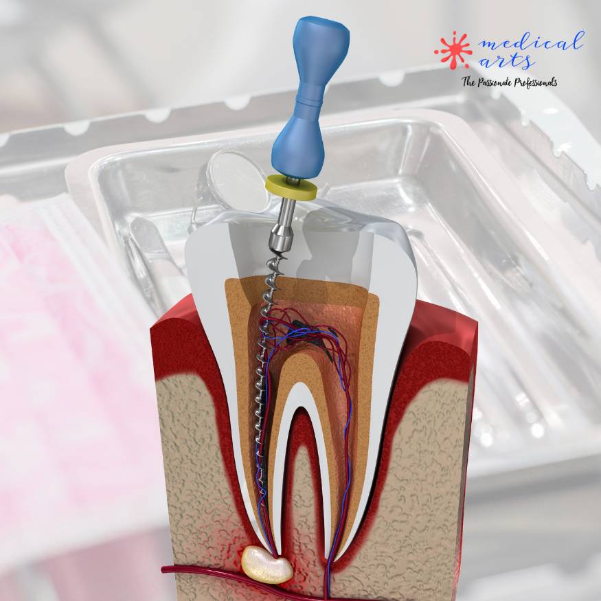 Dental Cavities - Tooth Abscess -Root Canal Treatment