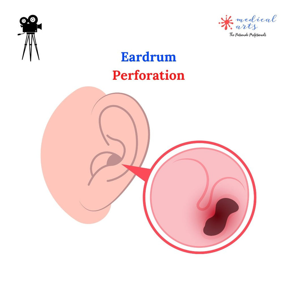 Eardrum Perforation 👂 – Medical Arts Shop
