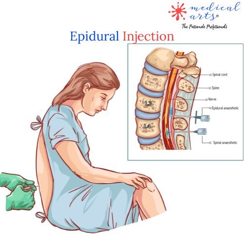 Epidural Injection - Epidural Anesthesia - Video Included