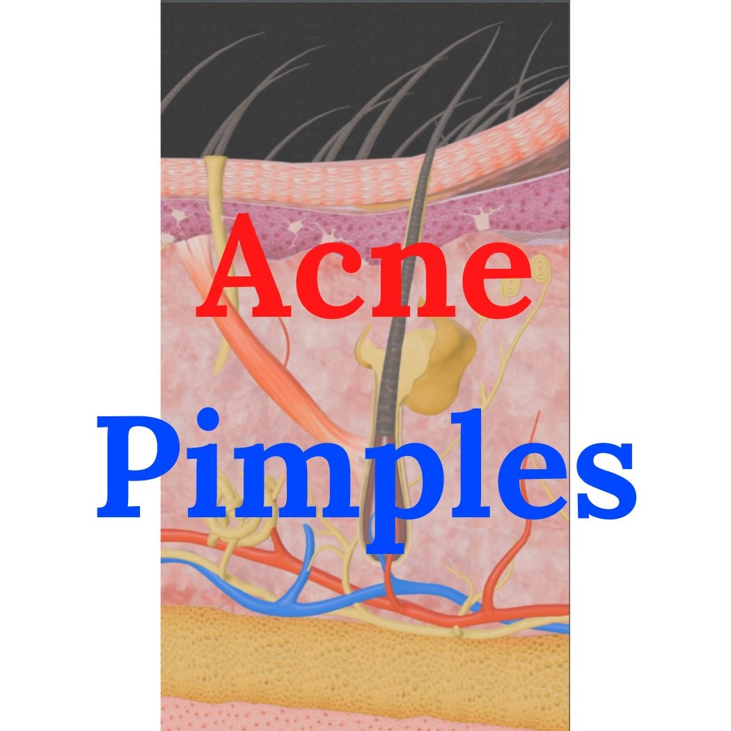 Everything you need to know about Acne, pimples - Video included