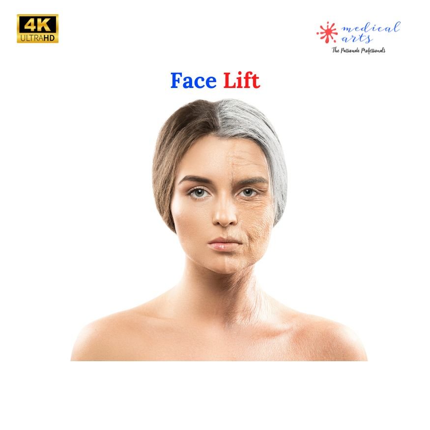 Face lift & Mini Face Lift Surgery - Video Included
