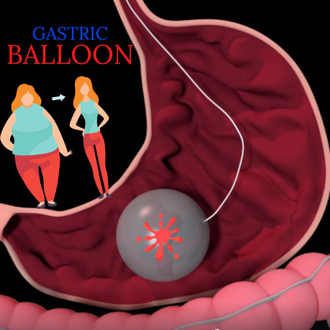 GASTRIC BALLOON [] bariatric surgery [] weight loss surgery