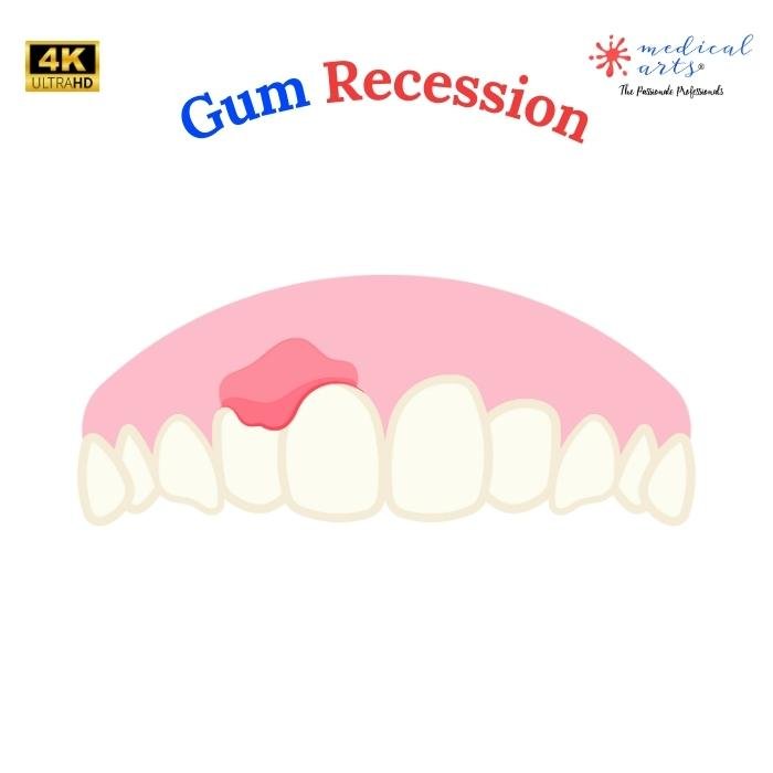 Gum Recession & Pyorrhea 🦷 Everything you need to know - Medical Arts.