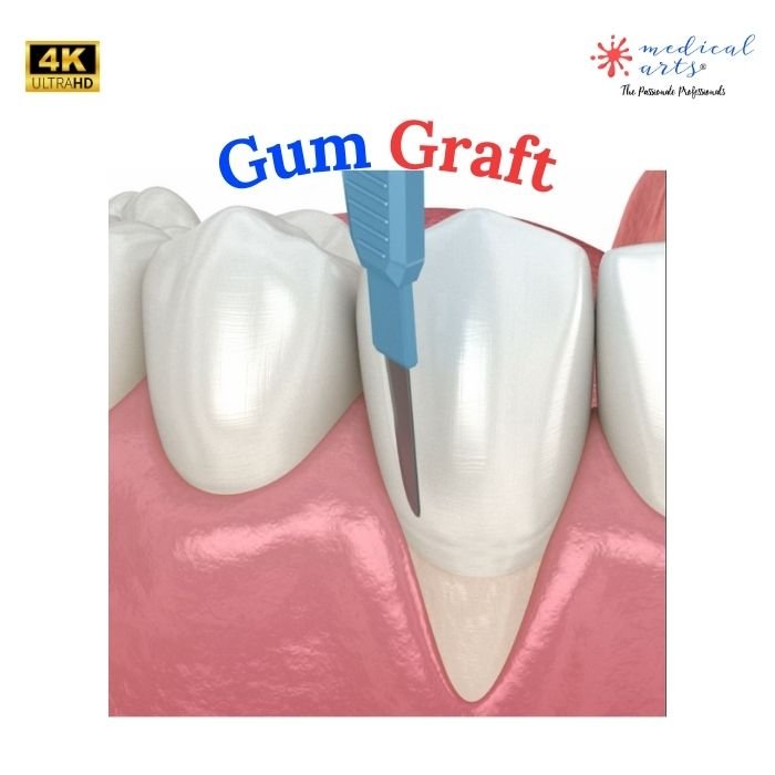 Gum recession surgical treatment - Gum Graft Surgery - Video Included