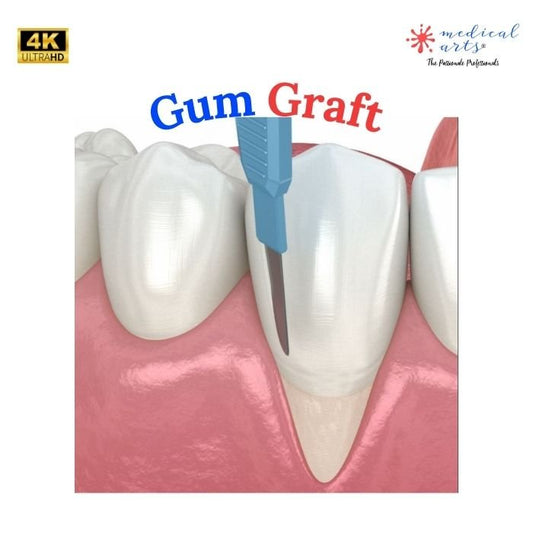 Gum recession surgical treatment - Gum Graft Surgery - Medical Arts Shop