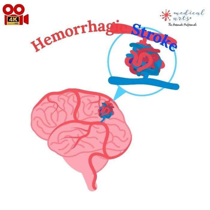 Hemorrhagic Stroke - CVA *Video included*