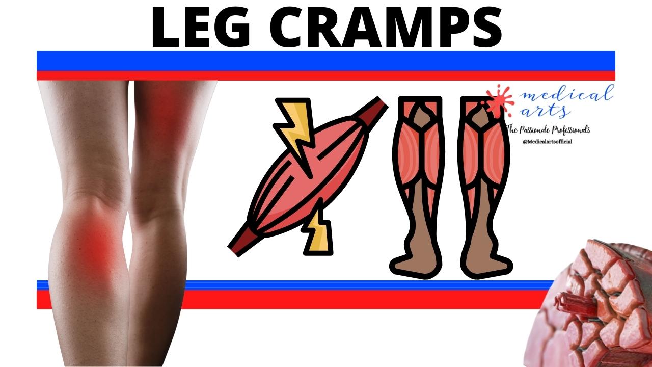 Leg Cramps, Muscle Spasms: Definition, Causes, Treatment, Prevention.