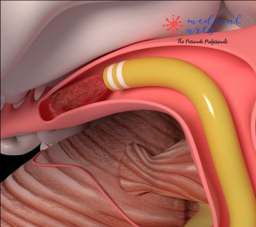 Mechanical Thrombectomy Stroke Animation