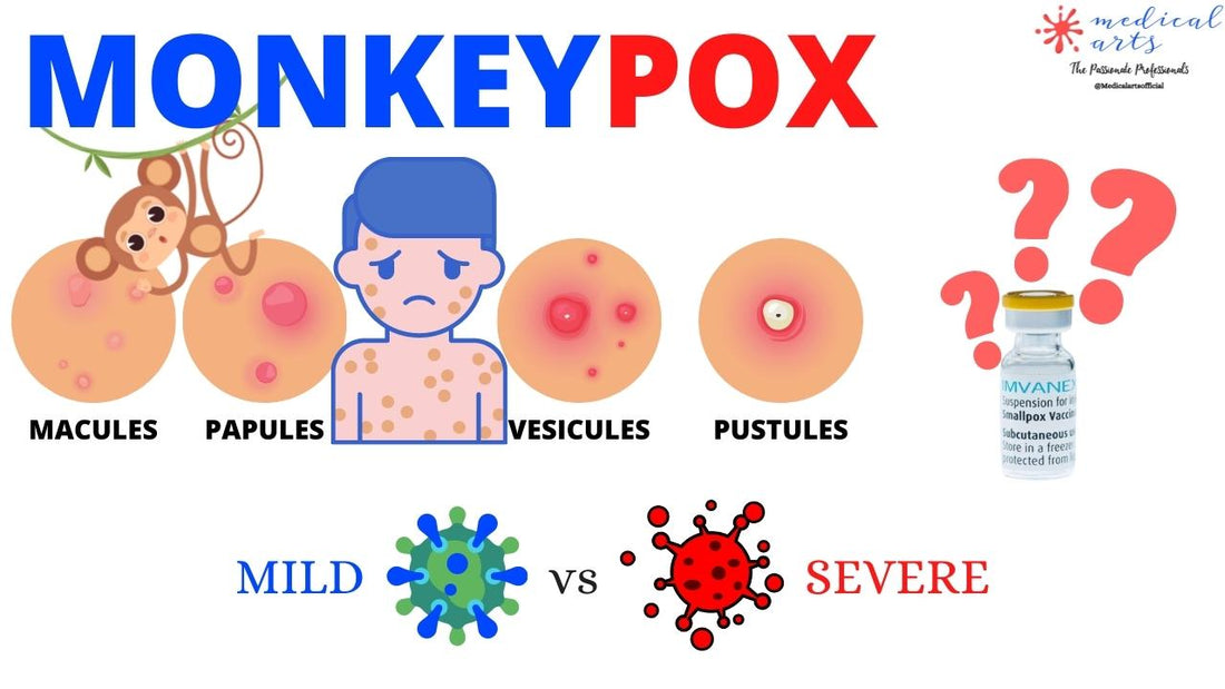 Monkeypox: Definition, Signs & Symptoms, High Risk Population, Diagnosis, Treatment and Preventions. - Medical Arts Shop