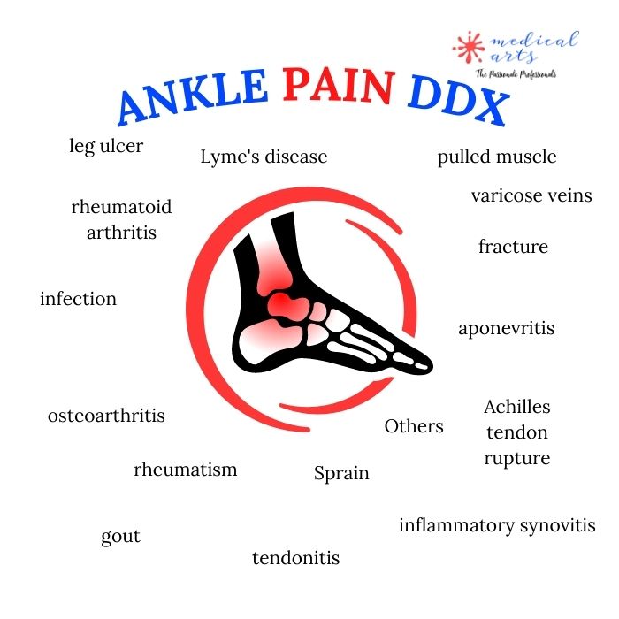 Most common causes of ankle pain - differential diagnosis ddx.
