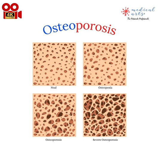 Osteoporosis - Osteopenia: A Closer Look into The Silent Epidemic - Medical Arts Shop