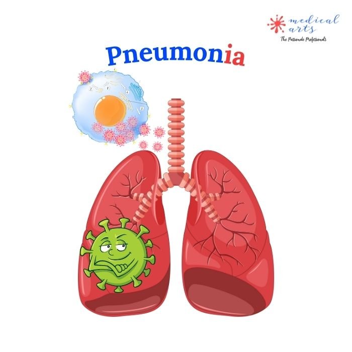 Pneumonia - Viral pneumonia : pathophysiology, symptoms, types and treatments. medical arts Video