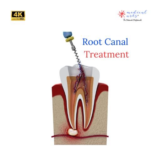 Process of Root Canal Treatment - Video