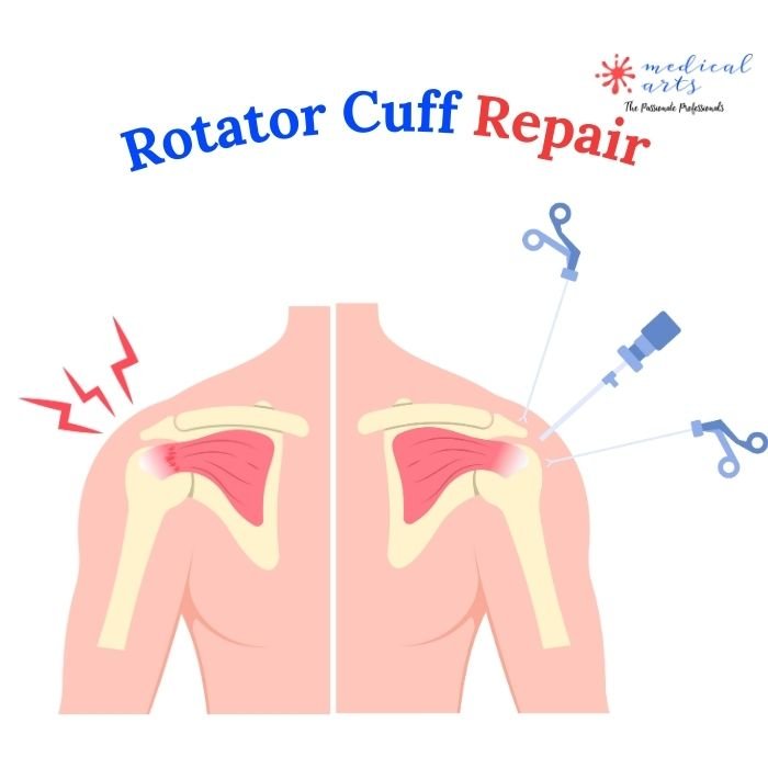 Rotator cuff tear treatments - Rotator cuff surgery – Medical Arts Shop