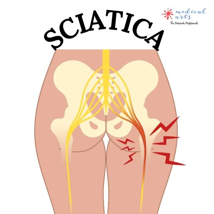 SCIATICA - Sciatic nerve pain causes, pathophysiology, symptoms and treatment. - Medical Arts Shop