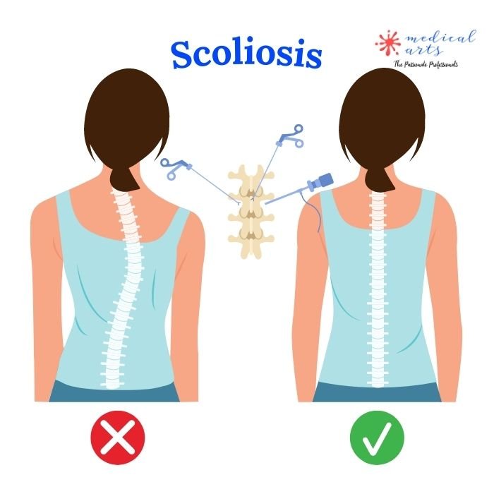 Scoliosis: types, causes, symptoms and treatment.