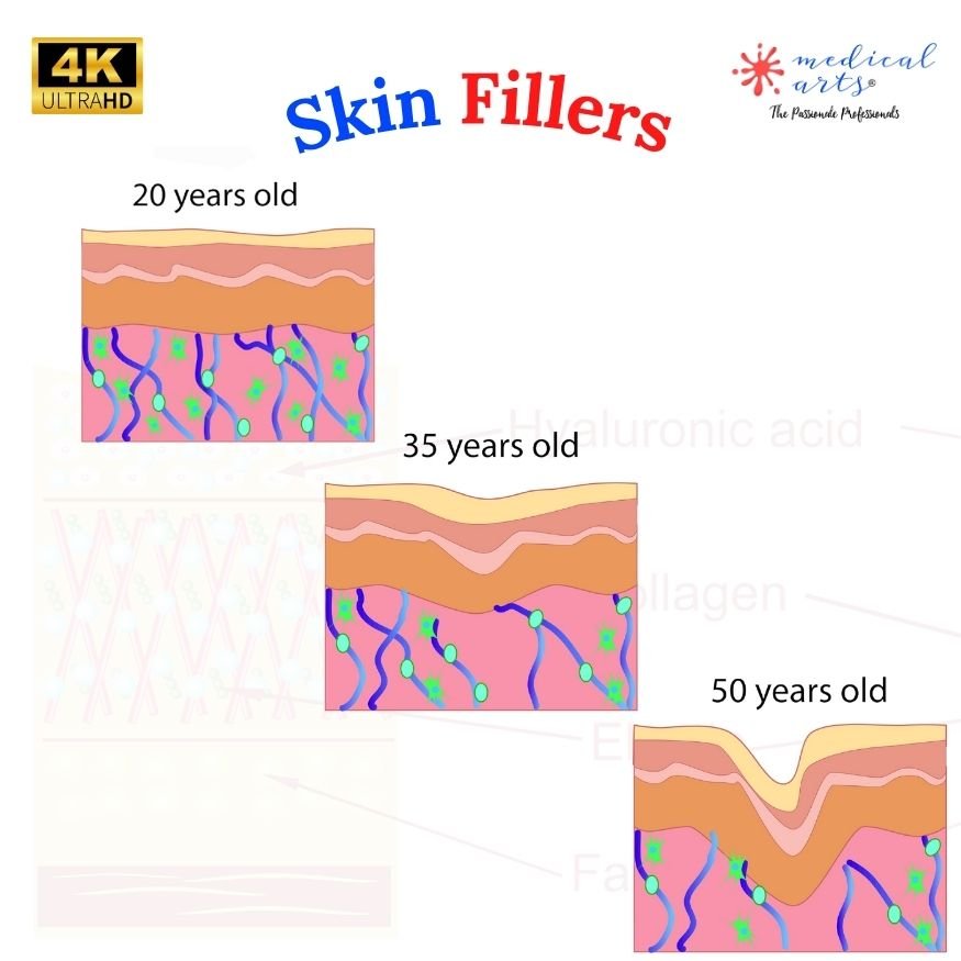 Skin Fillers, Wrinkles Treatment, and Natural Alternatives: A Friendly Guide by Medical Arts Shop