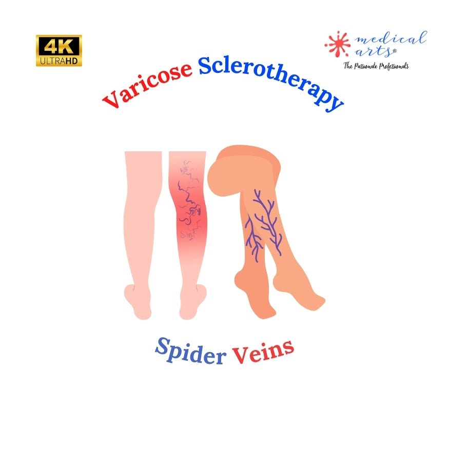 spider veins treatment - Varicose of the legs