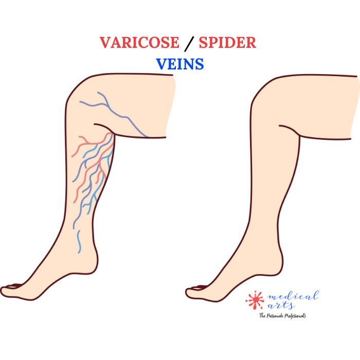 SPIDER veins / Varicose Veins  VS  NORMAL veins blood flow.