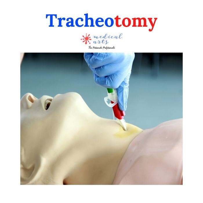 Tracheostomy, tracheotomy procedure explained & 3D animation – Medical ...