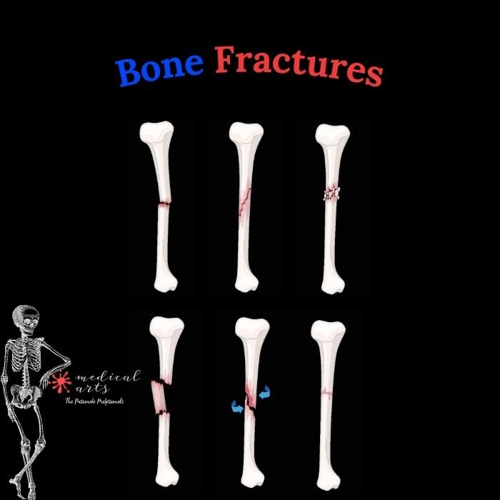 Types of fractures 🦴 Bone fractures - Medical Arts Shop