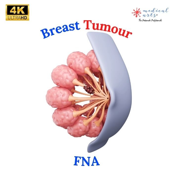 Understanding Breast Lumps & FineNeedle Aspiration FNA 🎥 - Video Included