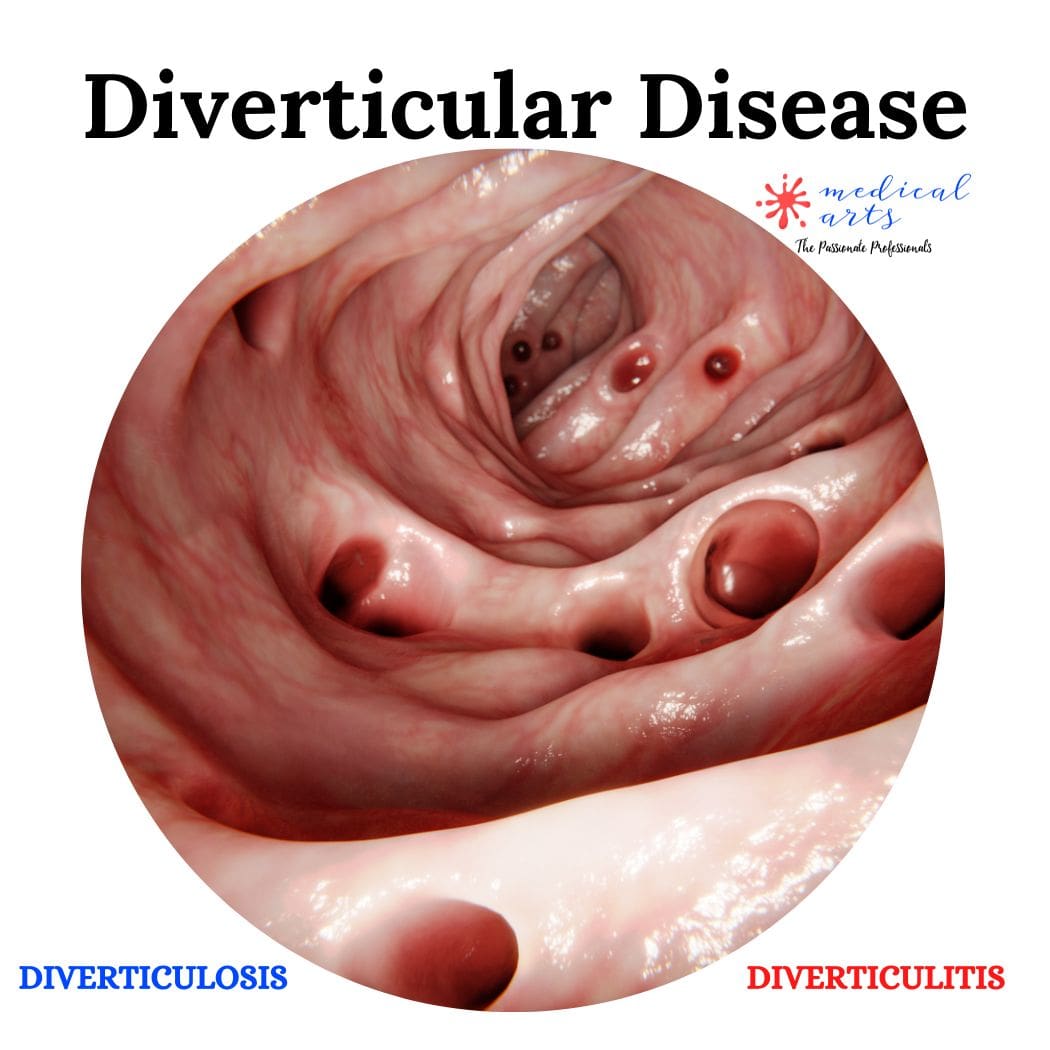 Understanding Diverticular Disease: Causes, Symptoms, and Treatment Options (diverticulosis & diverticulitis)