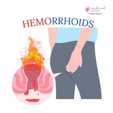 Understanding Hemorrhoids: Symptoms, causes and treatment.