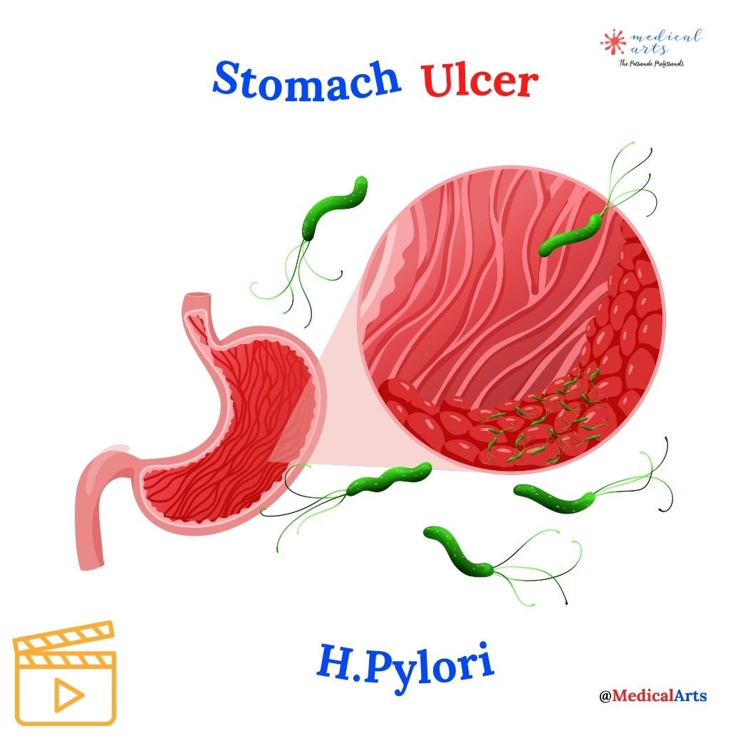 Unmasking Gastric Ulcers: Understanding Stomach Sores - Medical Animation Video