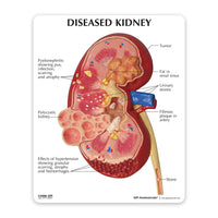 3D Diseased Kidney Dissected Anatomy Model - Medical Arts Shop