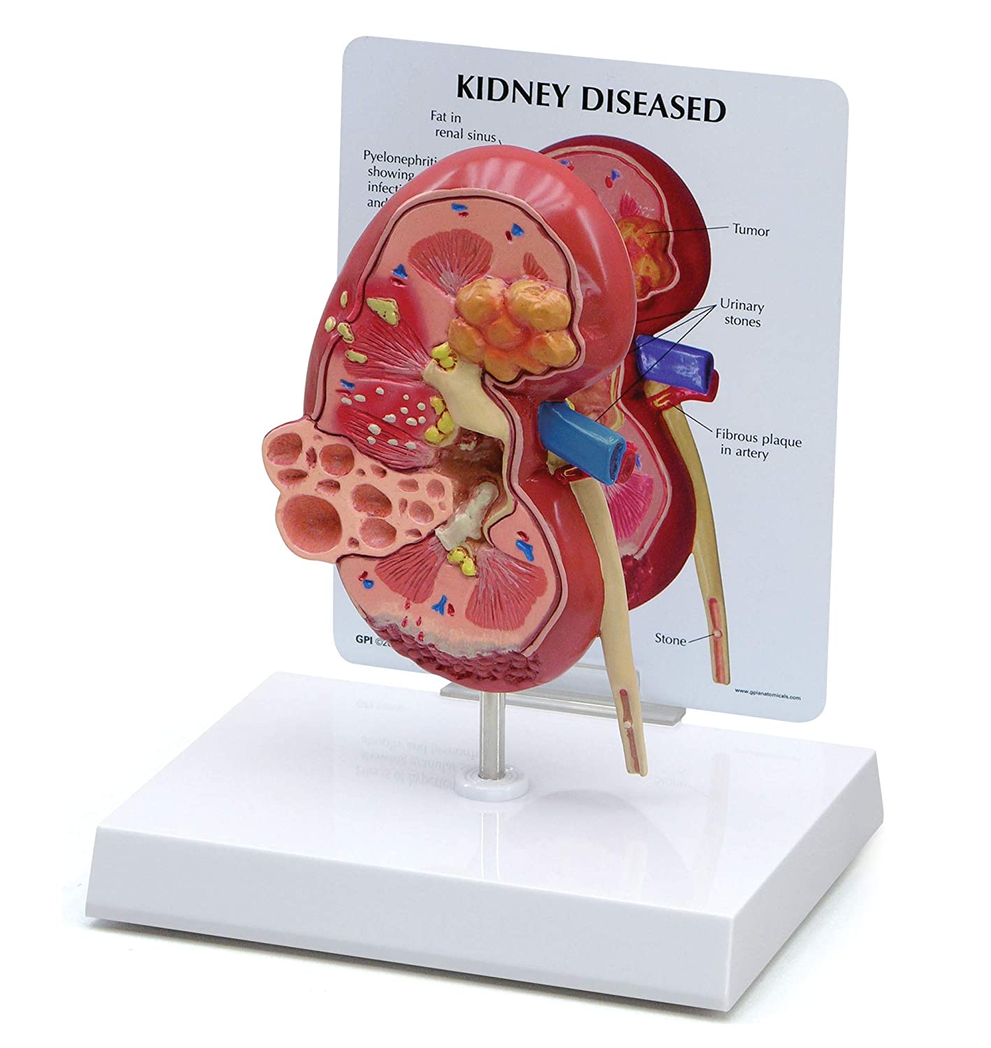 3D Diseased Kidney Dissected Anatomy Model